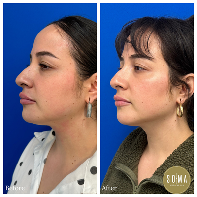 Kybella - Kybella is the first and only FDA-approved injectable treatment to improve the appearance of fat underneath the chin. When injected into the fat beneath the chin, KYBELLA® eliminates fat cells, resulting in a noticeable reduction in fullness under the chin. Once the fat cells are eliminated, these cells can no longer store or accumulate fat, so further treatment is not expected once you reach your desired aesthetic goal. An average of 3 to 6 treatments is needed for full optimal results. Kybella - Kybella is the first and only FDA-approved injectable treatment to improve the appearance of fat underneath the chin. When injected into the fat beneath the chin, KYBELLA® eliminates fat cells, resulting in a noticeable reduction in fullness under the chin. Once the fat cells are eliminated, these cells can no longer store or accumulate fat, so further treatment is not expected once you reach your desired aesthetic goal. An average of 3 to 6 treatments is needed for full optimal results.