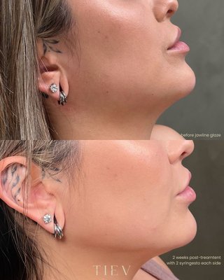 Jawline Filler - JAWLINE FILLER: bring structure back to your side profile with hyaluronic acid filler! Jawline Filler - JAWLINE FILLER: bring structure back to your side profile with hyaluronic acid filler!