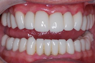 Before and Afters - Here are some before and after smiles performed by Dr. Orest Frangopol Before and Afters - Here are some before and after smiles performed by Dr. Orest Frangopol