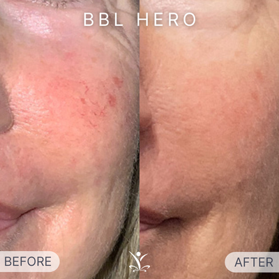 Laser Before & After Photos - Laser before and after photos. Laser Before & After Photos - Laser before and after photos.