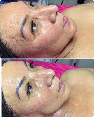 Microdermabrasion Package - My lovely client received a microdermabrasion package. Microdermabrasion is great from resurfacing her skin to give a beautiful soft complexion. Red LED Light therapy to stimulate collagen growth and a hydrogel mask to lock in serums to give her a youth, hydrated, smoothed finish. Microdermabrasion Package - My lovely client received a microdermabrasion package. Microdermabrasion is great from resurfacing her skin to give a beautiful soft complexion. Red LED Light therapy to stimulate collagen growth and a hydrogel mask to lock in serums to give her a youth, hydrated, smoothed finish.