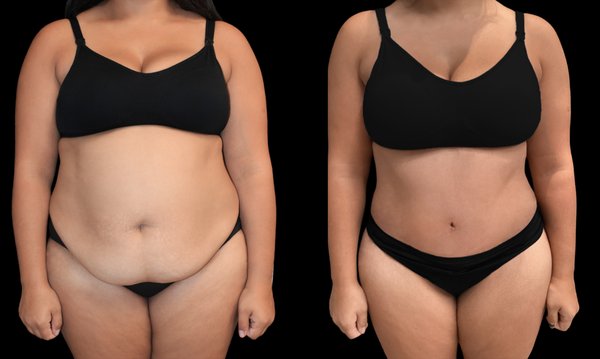 Tummy Tuck - The best candidates for Tummy Tuck are men and women with loose skin on the abdomen or fat areas that do not respond well to diet and exercise. This procedure is prevalent among women with fat accumulated in the lower abdomen due to weakened or damaged muscles after pregnancy or by the passage of time. Tummy Tuck - The best candidates for Tummy Tuck are men and women with loose skin on the abdomen or fat areas that do not respond well to diet and exercise. This procedure is prevalent among women with fat accumulated in the lower abdomen due to weakened or damaged muscles after pregnancy or by the passage of time.