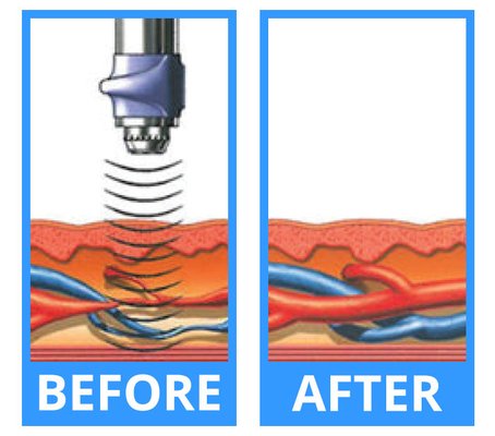 Erectile Dysfunction - How does it work?
Insufficient blood flow is often credited as the primary cause of sexual conditions, like erectile dysfunction and Peyronie’s disease.
To combat the negative effects of ED, Acoustic Therapy Center in Palo Alto, CA is thrilled to offer innovative treatments to stimulate blood flow to the penis and reinvigorate your intimate experiences. Acoustic wave therapy is a noninvasive procedure that utilizes acoustic shock waves to break up plaque in the arteries and stimulate ingrowth of new capillaries and stem cells to give you longer-lasting erections when the moment strikes. Erectile Dysfunction - How does it work?
Insufficient blood flow is often credited as the primary cause of sexual conditions, like erectile dysfunction and Peyronie’s disease.
To combat the negative effects of ED, Acoustic Therapy Center in Palo Alto, CA is thrilled to offer innovative treatments to stimulate blood flow to the penis and reinvigorate your intimate experiences. Acoustic wave therapy is a noninvasive procedure that utilizes acoustic shock waves to break up plaque in the arteries and stimulate ingrowth of new capillaries and stem cells to give you longer-lasting erections when the moment strikes.