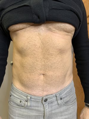High Definition Liposuction with Tickle Lipo and Renuvion Skin Tightening - This man is athletic but had some stubborn fat on his abdomen that would not go away with any amount of exercising. Dr. Song performed high definition liposuction using the "Tickle Lipo®" and Renuvion® skin tightening. We have since updated from Tickle to Vaser® liposuction which helps us perform this procedure in less time. High Def Lipo is an art. We can sculpt your body so you can show off those muscles you work so hard to develop.