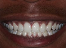 Invisalign® - Invisalign® Can Now Be Completed in
Half the Time!
The latest iteration of Invisalign can now provide the same great results in approximately half the time. The upgraded aligners use a new type of material that can move teeth into position faster than ever before. Instead of wearing each aligner for typically two weeks, many patients can wear them for just one week before moving on to the next tray in the series. We will go over this exciting development with you during your initial consultation so that you be well-informed about the new reduced treatment time. Invisalign® - Invisalign® Can Now Be Completed in
Half the Time!
The latest iteration of Invisalign can now provide the same great results in approximately half the time. The upgraded aligners use a new type of material that can move teeth into position faster than ever before. Instead of wearing each aligner for typically two weeks, many patients can wear them for just one week before moving on to the next tray in the series. We will go over this exciting development with you during your initial consultation so that you be well-informed about the new reduced treatment time.