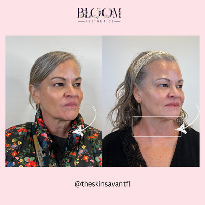 Tighter, smoother skin brought to you by Density RF. 💫 - MORE COLLAGEN = MORE VISIBLE RESULTS⚡️
DENSITY RF delivers up to 5X more collagen stimulation than Monopolar RF alone.🧞♂️
Improving skin snap and texture without surgery. 🤍 This beautiful patient chose Density RF to target the skin laxity on her face & neck. The goal was skin tightening and kickstarting new collagen production for a rejuvenated look. We are loving this transformation! Tighter, smoother skin brought to you by Density RF. 💫 - MORE COLLAGEN = MORE VISIBLE RESULTS⚡️
DENSITY RF delivers up to 5X more collagen stimulation than Monopolar RF alone.🧞♂️
Improving skin snap and texture without surgery. 🤍 This beautiful patient chose Density RF to target the skin laxity on her face & neck. The goal was skin tightening and kickstarting new collagen production for a rejuvenated look. We are loving this transformation!