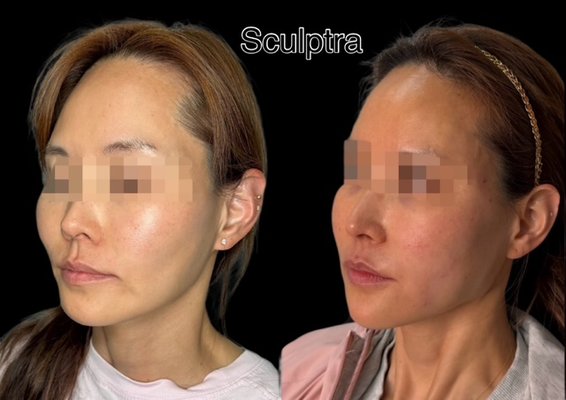 Sculptra/ Filler - This client was treated with Sculptra® in the submalar (mid-cheek hollow) area and temples to restore lost volume and support natural collagen production over time. Hyaluronic acid dermal filler was placed in the chin and cheeks to improve projection, balance facial proportions, and enhance overall facial harmony. The combination approach addresses both structural support and volume restoration for a natural, balanced result. Sculptra/ Filler - This client was treated with Sculptra® in the submalar (mid-cheek hollow) area and temples to restore lost volume and support natural collagen production over time. Hyaluronic acid dermal filler was placed in the chin and cheeks to improve projection, balance facial proportions, and enhance overall facial harmony. The combination approach addresses both structural support and volume restoration for a natural, balanced result.