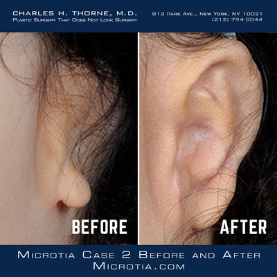Microtia Before & After Plastic Surgery - The term microtia literally means “small ear” but in reality indicates a small, abnormally shaped or absent external ear. Microtia can occur on one side only (unilateral) or on both sides ("bilateral). The unilateral form is much more common, occurring in approximately 90% of patients. As will be discussed below, microtia is tremendously variable. Some patients have small, almost normal appearing ears while others have completely absent ears. Some patients have no evidence of an ear canal and some have a blind canal. While some patients appear to have a true ear canal, these canals are almost always blind and to not communicate with the middle ear (more on this below under Aural Atresia). Some patients have a hairline that is in normal position, leaving appropriate, hairless skin for the reconstructed ear. Other patients have a low hairline and additional maneuvers are required to avoid a reconstructed ear that is partially or completely covered with hair.