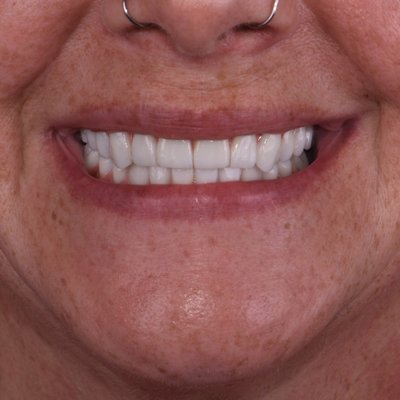 Smile with confidence💥 - We’re committed to providing you with quality care in a warm and friendly environment. Your health and confidence are our priority! – we love seeing smiles like this🦷 ✨ Smile with confidence💥 - We’re committed to providing you with quality care in a warm and friendly environment. Your health and confidence are our priority! – we love seeing smiles like this🦷 ✨