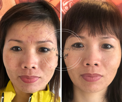 Six Months Skin Revision Program - She came to Beauty Journey Studio around middle of January 2020 with a simple goal on her mind, to improve her skin complexion. After initial consultation, I recommend 6 months skin revision. She started seeing improvement after third/fourth treatments. At home, she is religiously using her home care regimens I recommended. This makes the improvement progress as planned.
Unfortunately, the pandemic happened at the end of March by surprise. But, this did not stop her from the improvement progress because she kept up with her home care regimens and doing home treatments during the months of lock down. Recently, she just finished off the rest of her treatments.
On her last treatment, she expressed her gratefulness for joining and committing to the program and bravely heading down to her journey of beauty along with us. She gains more confidence in herself by exposing her face instead of wearing makeup to cover up the skin imperfection. I can't wait to see next month! Six Months Skin Revision Program - She came to Beauty Journey Studio around middle of January 2020 with a simple goal on her mind, to improve her skin complexion. After initial consultation, I recommend 6 months skin revision. She started seeing improvement after third/fourth treatments. At home, she is religiously using her home care regimens I recommended. This makes the improvement progress as planned.
Unfortunately, the pandemic happened at the end of March by surprise. But, this did not stop her from the improvement progress because she kept up with her home care regimens and doing home treatments during the months of lock down. Recently, she just finished off the rest of her treatments.
On her last treatment, she expressed her gratefulness for joining and committing to the program and bravely heading down to her journey of beauty along with us. She gains more confidence in herself by exposing her face instead of wearing makeup to cover up the skin imperfection. I can't wait to see next month!