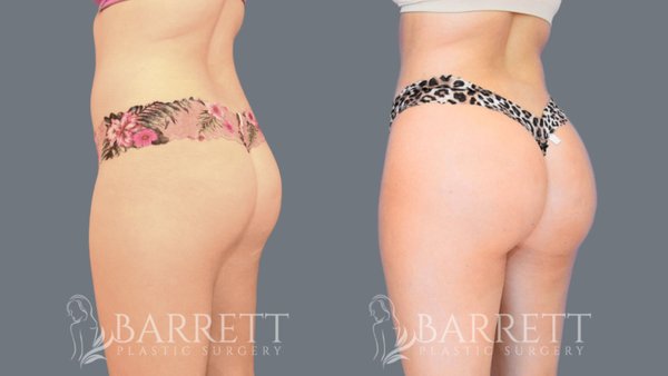 BBL Before & Afters 4 Months Post Op - The Brazilian Butt Lift (or BBL) is a two-step procedure where fat is harvested from one area and transferred to the outer thighs and buttocks, creating a rounded, hourglass body contour. The double benefits of sculpting and volumizing give an instant confidence boost. The Brazilian Butt Lift is an excellent option for people looking to remove stubborn fat from one area and enhance the size and shape of their backside and overall figure. It is essential to have sufficient fat to be harvested and realistic goals around what this procedure can achieve.

Patients with buttocks that have begun to droop or with substantial folds of loose skin are typically better candidates for a traditional butt lift, which includes repositioning the backside to a higher position while removing excess skin. This process can also be combined with a fat transfer for patients seeking added volume. During the initial consultation, Dr. Barrett will provide a comprehensive exam and discuss your goals to understand if this procedure is right for you.