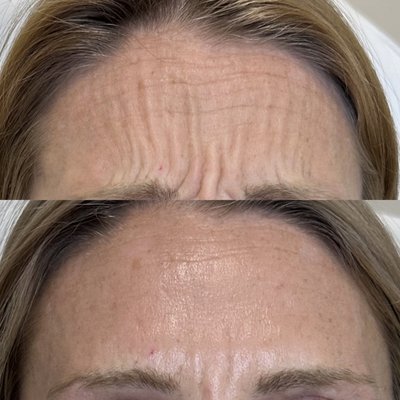Botox, Dysport, Jeuveau, and Daxxify - Here at Rumi we offer 4 different brands of "neurotoxins" or anti-wrinkle injections including Botox, Dysport, Jeuveau, and Daxxify. These treatments help smooth out wrinkles and prevent them from worsening. Treatments usually take about 30 minutes including the consultation process, has almost no down time, and results can last up to 6-9 months depending on the brand you choose! Our providers always ensure they tailor each treatment to your preference and can make results as "natural" or as frozen as you want. Botox, Dysport, Jeuveau, and Daxxify - Here at Rumi we offer 4 different brands of "neurotoxins" or anti-wrinkle injections including Botox, Dysport, Jeuveau, and Daxxify. These treatments help smooth out wrinkles and prevent them from worsening. Treatments usually take about 30 minutes including the consultation process, has almost no down time, and results can last up to 6-9 months depending on the brand you choose! Our providers always ensure they tailor each treatment to your preference and can make results as "natural" or as frozen as you want.