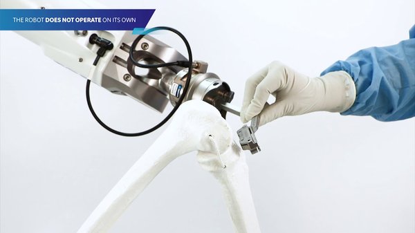 Robotic Hip and Knee Replacements - Traditionally, orthopedic surgeons replace joints manually using special tools. The surgeon has to choose and position the implant using his or her own judgement and visualization. Many surgeons successfully improve their patients’ pain and overall function using this manual method, but there are still some concerns that there is room for error. More recently, robotic-assisted surgery has become more popular as technology improves. Surgical robots are more precise, which offers multiple benefits throughout the surgery. Early results of several scientific studies have demonstrated that robotic assisted surgery has increased precision and better outcomes than manual orthopedic surgery for certain joint replacement procedures. Patients who undergo robot-assisted surgeries have less pain, less swelling and stiffness, and improved function compared to the patients who had conventional surgery. There are benefits of each robotic system available. Robotic Hip and Knee Replacements - Traditionally, orthopedic surgeons replace joints manually using special tools. The surgeon has to choose and position the implant using his or her own judgement and visualization. Many surgeons successfully improve their patients’ pain and overall function using this manual method, but there are still some concerns that there is room for error. More recently, robotic-assisted surgery has become more popular as technology improves. Surgical robots are more precise, which offers multiple benefits throughout the surgery. Early results of several scientific studies have demonstrated that robotic assisted surgery has increased precision and better outcomes than manual orthopedic surgery for certain joint replacement procedures. Patients who undergo robot-assisted surgeries have less pain, less swelling and stiffness, and improved function compared to the patients who had conventional surgery. There are benefits of each robotic system available.