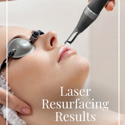 Laser Resurfacing - Laser resurfacing is a procedure that uses an energy-based device to improve the look and feel of skin. It's usually used to reduce fine lines, age spots and uneven skin color in the face Laser Resurfacing - Laser resurfacing is a procedure that uses an energy-based device to improve the look and feel of skin. It's usually used to reduce fine lines, age spots and uneven skin color in the face