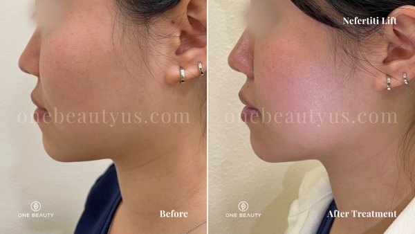 Nefertiti Lift w/ Botox injection - The Nefertiti Lift is a non-surgical cosmetic procedure using Botox injections to temporarily redefine the jawline and neck area. It targets the platysma muscles, which can pull the jawline downward and contribute to sagging skin. As these muscles become more active with age, they can distort the lower face contour. By relaxing these muscles, the Nefertiti Lift helps create a more defined jawline and smoother neck, restoring balance to the facial profile. Nefertiti Lift w/ Botox injection - The Nefertiti Lift is a non-surgical cosmetic procedure using Botox injections to temporarily redefine the jawline and neck area. It targets the platysma muscles, which can pull the jawline downward and contribute to sagging skin. As these muscles become more active with age, they can distort the lower face contour. By relaxing these muscles, the Nefertiti Lift helps create a more defined jawline and smoother neck, restoring balance to the facial profile.