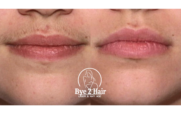 6 Sessions Upper Lip Laser for $99 - Say goodbye to unwanted upper lip hair with our 6-session laser package for just $99!
Quick, gentle, and effective — this treatment is perfect for achieving long-lasting smoothness in one of the most delicate areas 🩵
✨ FDA-approved technology
✨ Minimal discomfort, zero downtime
✨ Save time and ditch the razor
📅 Book now at https://bye2hair.glossgenius.com/book 6 Sessions Upper Lip Laser for $99 - Say goodbye to unwanted upper lip hair with our 6-session laser package for just $99!
Quick, gentle, and effective — this treatment is perfect for achieving long-lasting smoothness in one of the most delicate areas 🩵
✨ FDA-approved technology
✨ Minimal discomfort, zero downtime
✨ Save time and ditch the razor
📅 Book now at https://bye2hair.glossgenius.com/book