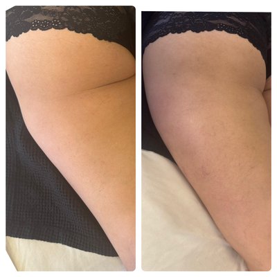 Radio frequency contour - This is one session of tedious frequency contour. It is an hour of massage and rf on the area desired. Radio frequency contour - This is one session of tedious frequency contour. It is an hour of massage and rf on the area desired.