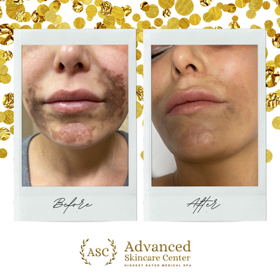 Pixel Laser Treatments - Results you can see! Just look at the transformation with a single treatment of PIXEL resurfacing laser. Call to book your appointment for a free consultation to see if this treatment is right for you.