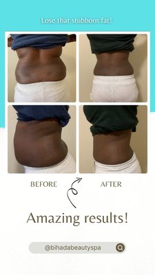 Body Contouring Client Amazing Results - Customer wanted help to get rid of love handles and lower back/belly fat, we gladly help on their adventure to achieve their dream body!

You have any stubborn fat that just refuse to go away such as love handles, lower back/belly fat, the infamous double chin or other part of your body? we can help you get rid or it and get that body you always have dream.