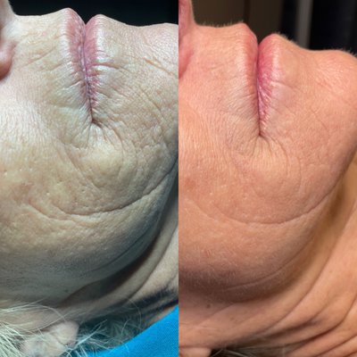 PRX T 33 Peel - The PRX-T33 bio revitalization peel is an innovative technique of TCA peel that stimulates the regeneration of the skin without involving exfoliation of the epidermis. It helps to strengthen the radiance and brightness of the skin, correct skin imperfections of the skin and reduce stretch marks.