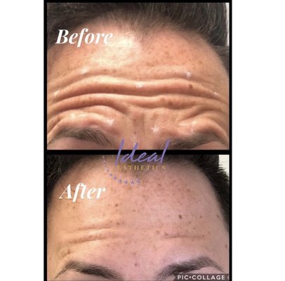 Anti-aging Treatment - These photos illustrate wrinkle treatment with products such as Botox, Dysport & Xeomin. The treatment is quick and painless, and the results last approximately 3-5 months. Anti-aging Treatment - These photos illustrate wrinkle treatment with products such as Botox, Dysport & Xeomin. The treatment is quick and painless, and the results last approximately 3-5 months.