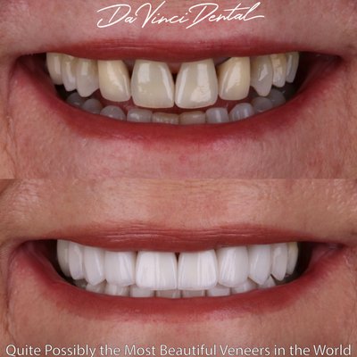 Shocking "Before and Afters" - Get a gorgeous smile without destroying your teeth! Don’t let your teeth be drilled down to stumps now that “100% Drill-free Veneers™” and “Minimal Drill Veneers” are possible exclusively at Da Vinci Dental in Bellevue. Not one tooth is drilled down excessively and there is no painful recovery time! Many people have chosen to get the smile they’ve always wished for now that their teeth can remain nearly untouched. Our gorgeous patient above is a prime example of our World-Class Drill Free and Minimal Drill Veneers.⁣
⁣
You may have heard that in order to have Veneers placed, your real teeth need to be drilled down to stumps! 😱This is unnecessary as excess removal of your healthy enamel is horribly damaging to your natural teeth. Our Minimal Drill Veneers™ (exclusively at Da Vinci Dental in Bellevue) are the safest solution! Add length, close spaces, straighten teeth, reverse damage, and permanently whiten your smile all at once- without the fear of damaging your perfectly healthy teeth.
⁣
With our World-Class Veneers, you can also erase your fear of getting the dreaded “chiclets” or fake looking Veneers. Examine our other high definition photos on our page to appreciate all the intricate details which make our Veneers perhaps the most realistic and beautiful in the world. Obtain the smile you’ve always wished you could have, now completely safe and so realistic it looks like you were born with it! Call to schedule your free smile consultation today!⁣