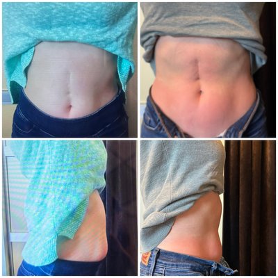 Body Contouring - Call now to book your appointment for our $199 new client special