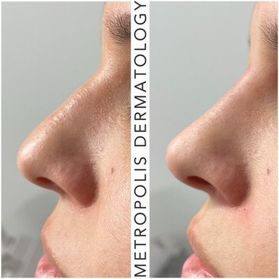 Liquid Rhinoplasty - Liquid Rhinoplasties are advanced procedures that seek to contour the nose without surgery. Liquid Rhinoplasty - Liquid Rhinoplasties are advanced procedures that seek to contour the nose without surgery.