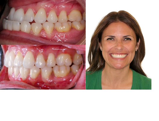 Dr. Wong is highly regarded among surgeons, throughout the US, for his superior surgical-orthodontic planning and precise execution. - Cassandra came to our office to correct her “underbite” (underjet of lower incisors beyond upper incisors).  The cause of Cassandra’s malocclusion was a disproportionately large and asymmetric lower jaw.  To properly align the teeth and bring greater balance to the face, Dr. Wong prescribed orthognathic jaw surgery of the mandible and a customized treatment plan utilizing Invisalign aligners to set up Cassandra’s dentition for ideal occlusion post-surgery.  Cassandra was an excellent patient, wearing aligners as prescribed before and after surgery. Her beautiful smile and face are testaments to the benefit of excellent surgically-involved treatment.