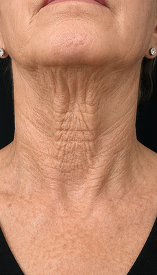 Fractional CO2 Laser Neck Rejuvenation - This visual series highlights a fractional CO2 laser neck resurfacing treatment designed to improve the look of crepey texture, fine lines, wrinkles, and overall skin quality on the neck. The photos show the treatment journey from visible laxity and wrinkling, to the red recovery phase, to a smoother and more refreshed-looking neckline after healing. Fractional CO2 Laser Neck Rejuvenation - This visual series highlights a fractional CO2 laser neck resurfacing treatment designed to improve the look of crepey texture, fine lines, wrinkles, and overall skin quality on the neck. The photos show the treatment journey from visible laxity and wrinkling, to the red recovery phase, to a smoother and more refreshed-looking neckline after healing.