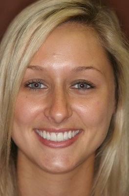 Gallery of Smiles - Your Dream Smile Is Possible
Ready to rediscover your best smile and self-confidence? Reach out to Alafaya Center for Cosmetic & Family Dentistry and unveil the potential of cosmetic dentistry in Orlando, FL. Your dream smile awaits!