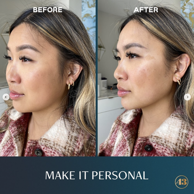 Make It Personal Results - Make it Personal is our signature custom microtreatment that consists of a specifically tailored combination of wrinkle relaxers and dermal fillers.