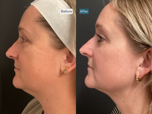 Regenerative Treatments - Harness the power of regenerative aesthetics with advanced treatments like Sculptra®, Radiesse®, Renuva®, and Salmon DNA (PDRN). Stimulate collagen, restore volume, and rejuvenate skin quality from within. Regenerative Treatments - Harness the power of regenerative aesthetics with advanced treatments like Sculptra®, Radiesse®, Renuva®, and Salmon DNA (PDRN). Stimulate collagen, restore volume, and rejuvenate skin quality from within.