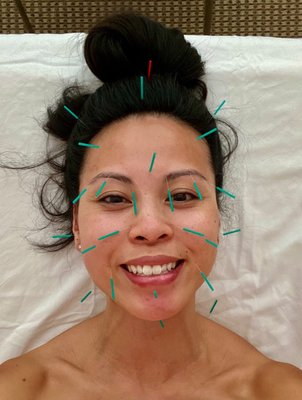 Facial Rejuvenation - Facial Rejuvenation with Acupuncture and Traditional Chinese Medicine - Revitalize Your Beauty Naturally
Embark on a transformative journey of facial rejuvenation guided by acupuncture and Traditional Chinese Medicine (TCM). Explore the natural path to a radiant appearance, harmonizing your inner vitality and outer allure.
Discover the Essence of Facial Rejuvenation - Unveiling Ageless Beauty the TCM Way
Embark on a holistic approach to facial rejuvenation, rooted in the wisdom of acupuncture and TCM. Restore your face’s youthful glow, addressing imbalances and revitalizing your skin’s natural radiance.
The Healing Touch of Acupuncture for Facial Rejuvenation - Elevate Beauty with Ancient Wisdom
Experience the gentle power of acupuncture for facial rejuvenation, a time-tested technique that enhances your skin’s vitality. Through precise needle placement, energy blockages are released, encouraging a refreshed and radiant complexion. Facial Rejuvenation - Facial Rejuvenation with Acupuncture and Traditional Chinese Medicine - Revitalize Your Beauty Naturally
Embark on a transformative journey of facial rejuvenation guided by acupuncture and Traditional Chinese Medicine (TCM). Explore the natural path to a radiant appearance, harmonizing your inner vitality and outer allure.
Discover the Essence of Facial Rejuvenation - Unveiling Ageless Beauty the TCM Way
Embark on a holistic approach to facial rejuvenation, rooted in the wisdom of acupuncture and TCM. Restore your face’s youthful glow, addressing imbalances and revitalizing your skin’s natural radiance.
The Healing Touch of Acupuncture for Facial Rejuvenation - Elevate Beauty with Ancient Wisdom
Experience the gentle power of acupuncture for facial rejuvenation, a time-tested technique that enhances your skin’s vitality. Through precise needle placement, energy blockages are released, encouraging a refreshed and radiant complexion.