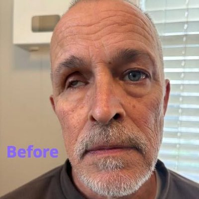 Patient Before and After - This patient had old artificial eye replaced. Patient Before and After - This patient had old artificial eye replaced.