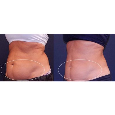 CoolSculpting® Elite – ONE TREATMENT Before & After Transformation - At Contour You Med Spa in Scottsdale, our patients trust us for reliable, natural-looking body transformation—without surgery or significant downtime. Our specialty is CoolSculpting® Elite, the industry’s most advanced, FDA-cleared non-surgical fat reduction technology.
What is CoolSculpting® Elite?
CoolSculpting® Elite uses targeted, controlled cooling to freeze and eliminate stubborn fat cells that resist diet and exercise. It’s ideal for sculpting common “trouble spots” like the abdomen, flanks (“love handles”), inner/outer thighs, arms, back, and under the chin. The treatment is safe, effective, and involves no needles, anesthesia, or scars.
Patient Experience—What To Expect
Before: Many of our clients are frustrated by areas of pinchable fat that seem impossible to lose, even with diligent fitness and nutrition efforts. Popular areas include the tummy, love handles, and lower back.
During Treatment: After mapping your unique anatomy, our certified team applies custom CoolSculpting® Elite applicators. The process is comfortable, typically requiring only minimal downtime—most clients read, relax, or work on their devices during the session. Treatments are overseen by Dr. Scott Siverhus and our advanced staff, ensuring maximum safety and effectiveness.
After: Results are gradual—over the following weeks, your body’s natural processes remove the crystallized fat cells for good. As seen in these photos:
Front View: Notice the significant reduction in abdominal volume and improved midsection contour, revealing a flatter, more sculpted appearance.
Side View: The lower belly “bulge” shrinks, creating a sleeker, tighter profile with more visible definition and confidence in fitted clothes.
Why Patients Love CoolSculpting® at Contour You
Medically supervised & mapped for your body and goals
Effective, visible fat reduction with no anesthesia or surgical scars
Multiple treatment areas in one session
Little to no social downtime
Personalized maintenance plans for lasting results
Is CoolSculpting® Right for You?
Ideal candidates are at or near their target weight but want to address isolated areas of stubborn fat. Each patient receives a thorough consultation with our experts so you feel educated, empowered, and confident in your decision.
Ready for your own before & after?
Book a complimentary CoolSculpting® Elite assessment at Contour You and get started on your journey to your best shape yet! CoolSculpting® Elite – ONE TREATMENT Before & After Transformation - At Contour You Med Spa in Scottsdale, our patients trust us for reliable, natural-looking body transformation—without surgery or significant downtime. Our specialty is CoolSculpting® Elite, the industry’s most advanced, FDA-cleared non-surgical fat reduction technology.
What is CoolSculpting® Elite?
CoolSculpting® Elite uses targeted, controlled cooling to freeze and eliminate stubborn fat cells that resist diet and exercise. It’s ideal for sculpting common “trouble spots” like the abdomen, flanks (“love handles”), inner/outer thighs, arms, back, and under the chin. The treatment is safe, effective, and involves no needles, anesthesia, or scars.
Patient Experience—What To Expect
Before: Many of our clients are frustrated by areas of pinchable fat that seem impossible to lose, even with diligent fitness and nutrition efforts. Popular areas include the tummy, love handles, and lower back.
During Treatment: After mapping your unique anatomy, our certified team applies custom CoolSculpting® Elite applicators. The process is comfortable, typically requiring only minimal downtime—most clients read, relax, or work on their devices during the session. Treatments are overseen by Dr. Scott Siverhus and our advanced staff, ensuring maximum safety and effectiveness.
After: Results are gradual—over the following weeks, your body’s natural processes remove the crystallized fat cells for good. As seen in these photos:
Front View: Notice the significant reduction in abdominal volume and improved midsection contour, revealing a flatter, more sculpted appearance.
Side View: The lower belly “bulge” shrinks, creating a sleeker, tighter profile with more visible definition and confidence in fitted clothes.
Why Patients Love CoolSculpting® at Contour You
Medically supervised & mapped for your body and goals
Effective, visible fat reduction with no anesthesia or surgical scars
Multiple treatment areas in one session
Little to no social downtime
Personalized maintenance plans for lasting results
Is CoolSculpting® Right for You?
Ideal candidates are at or near their target weight but want to address isolated areas of stubborn fat. Each patient receives a thorough consultation with our experts so you feel educated, empowered, and confident in your decision.
Ready for your own before & after?
Book a complimentary CoolSculpting® Elite assessment at Contour You and get started on your journey to your best shape yet!