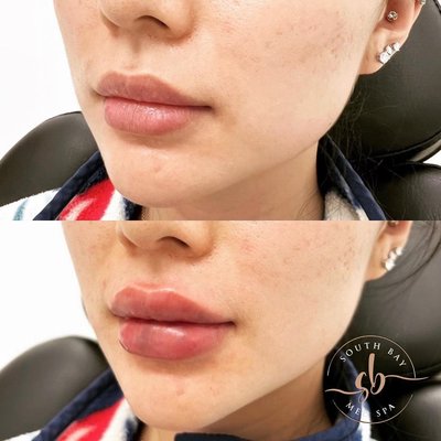 Botox & Dermal Fillers - Offering the best Botox Injections in Torrance by South Bay Med Spa, a top 10% Allergan provider of injectables in for the South bay of LA. South Bay Med Spa of Torrance has also been an experienced Juvederm provider since 2012.