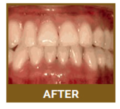 Underbite - What is it? As with a deep overbite, an underbite is usually caused by the lower jaw being poorly aligned. In these cases, the lower teeth are aligned in front of the upper row. In severe examples, there may even be a gap between the upper and lower teeth at the front, which can make it hard to chew and lead to jaw pain, enamel erosion, and other issues.

How is it treated? Interventions are most successful when treatment is started as early as possible. For children, a choice might be made between external headgear and expanders. For adults, surgery might be necessary as well.