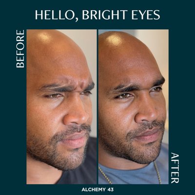 Botox/Dysport Results - Wrinkle relaxers such as Botox and Dysport aid in smoothing out fine lines for a refreshed look. Botox/Dysport Results - Wrinkle relaxers such as Botox and Dysport aid in smoothing out fine lines for a refreshed look.