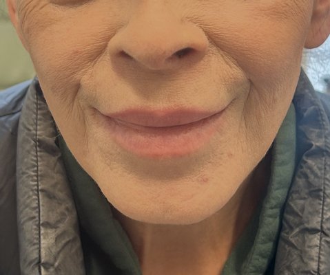 Lip Flip Before and After - Lip Flips are such an impactful change even though they are subtle! Lip Flip Before and After - Lip Flips are such an impactful change even though they are subtle!