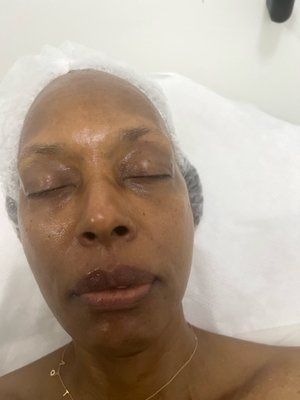 LED Treatment - LED treatment facials offer a non-invasive skincare solution, utilizing various wavelengths of light to target specific skin concerns such as acne, inflammation, and signs of aging. These services are known for their ability to stimulate collagen production, improve skin texture, and reduce the appearance of fine lines and wrinkles, providing a rejuvenating and glowing complexion. With minimal downtime and impressive results, LED treatment facials are increasingly popular for their effectiveness and versatility in addressing diverse skin issues.