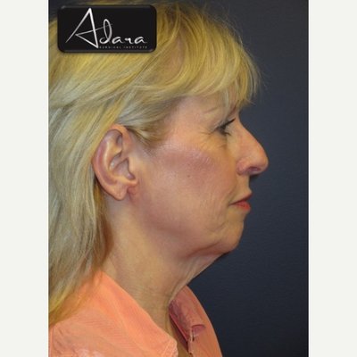 Before & After Facelift on a 45-54 year old woman - Before & After Facelift on a 45-54 year old woman Before & After Facelift on a 45-54 year old woman - Before & After Facelift on a 45-54 year old woman