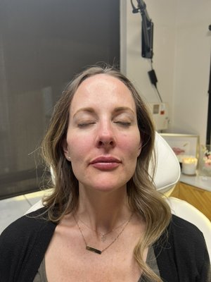 8 point lift and subtle lip plump - This patient wanted to soften her marionette and add a lip plump as well as look refreshed. We achieved this by performing an 8 point lift and lip filler. Notice the softening of the lines around her mouth, beautifully lifted cheeks and a subtle lip plump. 8 point lift and subtle lip plump - This patient wanted to soften her marionette and add a lip plump as well as look refreshed. We achieved this by performing an 8 point lift and lip filler. Notice the softening of the lines around her mouth, beautifully lifted cheeks and a subtle lip plump.