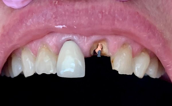 Surgical Extraction and Bridge Restoration - This case portrays a Surgical Extraction and Bridge Restoration done Surgical Extraction and Bridge Restoration - This case portrays a Surgical Extraction and Bridge Restoration done