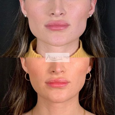 Masseter or Jaw Slimming using Toxins - Toxins like Botox and Dysport can be used in the masseter muscles to treat both TMJ pain and help slim the jawline.
For TMJ, the treatment relaxes overactive jaw muscles to reduce clenching, tension, and pain.
For jaw slimming, it gradually shrinks the muscle over time, creating a softer, more contoured look.
One treatment, two benefits — both therapeutic and cosmetic! Masseter or Jaw Slimming using Toxins - Toxins like Botox and Dysport can be used in the masseter muscles to treat both TMJ pain and help slim the jawline.
For TMJ, the treatment relaxes overactive jaw muscles to reduce clenching, tension, and pain.
For jaw slimming, it gradually shrinks the muscle over time, creating a softer, more contoured look.
One treatment, two benefits — both therapeutic and cosmetic!