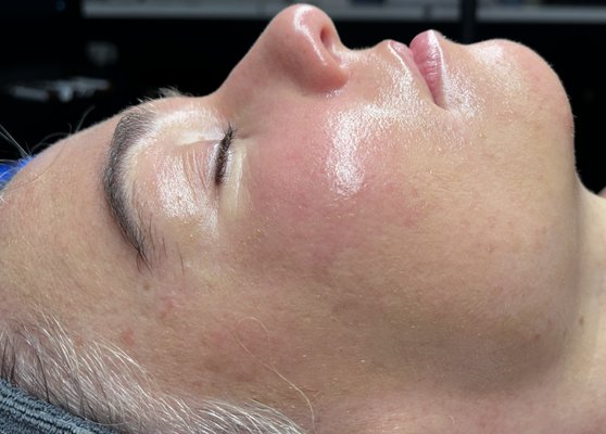 1 year of Monthly Hydrafacials - With a little help from your Estie-Besties, and some dedication to your home care regimen, you too can have results like this in just 1 year of consistent, monthly hydrafacials at Mynx Aesthetik!