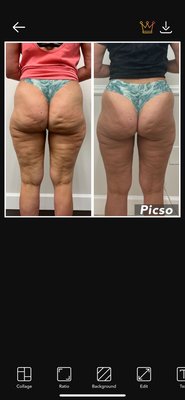 Cryo + Cavitation - This is one of our customers that needed to loose fat and reduce stretchmarks.
The results speak for themselves.
Don't wait, give us a call today and book your free consultation! Cryo + Cavitation - This is one of our customers that needed to loose fat and reduce stretchmarks.
The results speak for themselves.
Don't wait, give us a call today and book your free consultation!