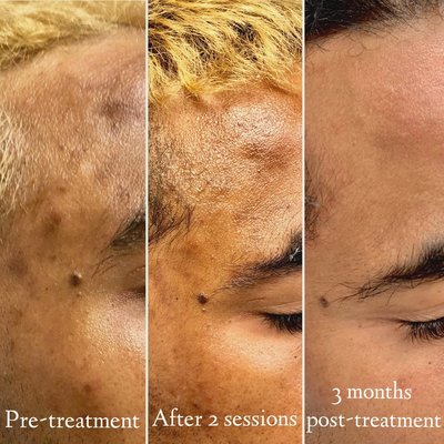 Pigmentation Treatment - We use a variety of pigment lasers, including the Hollywood Spectra, BBL/Halo, LaseMD Ultra, and other technologies to tackle hard to treat spots. Pigmentation Treatment - We use a variety of pigment lasers, including the Hollywood Spectra, BBL/Halo, LaseMD Ultra, and other technologies to tackle hard to treat spots.