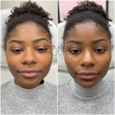 Mid-Face & Lower-Face Fillers - Chin, jawline, and mid-face cheek filler help to balance profiles, elongate the face shape and lift the mid-face. Check out these amazing before and after photos! Mid-Face & Lower-Face Fillers - Chin, jawline, and mid-face cheek filler help to balance profiles, elongate the face shape and lift the mid-face. Check out these amazing before and after photos!