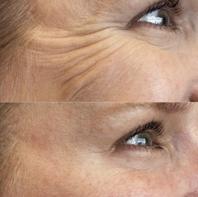 Botox/Dysport - Our expert injectors use neuromodulator brands Botox and Dysport to soften crow’s feet, frown lines, forehead lines and other dynamic wrinkles. They may also be used to lift the brows non-surgically, define the jawline, or enhance the lips (AKA lip flip).